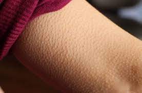 Why do we get goosebumps